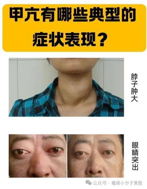 甲亢患者也要补充营养，建议多吃两类食物！