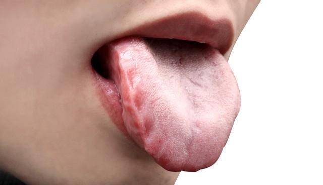 别再瞎健脾祛湿！齿痕舌+白腻苔，多半是肝郁堵了，这样调才管用