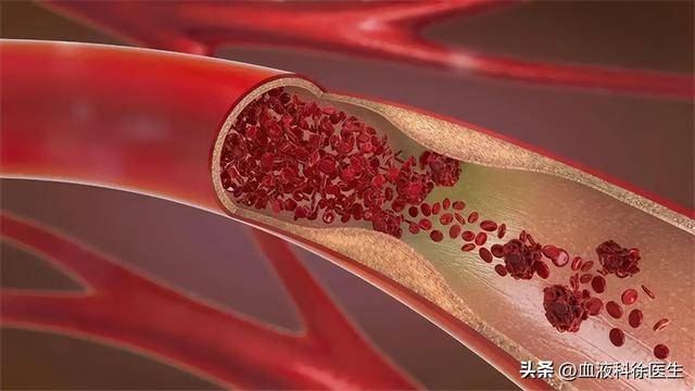 注意！晨起4个表现，警惕血脂超标！快看看你中了没？