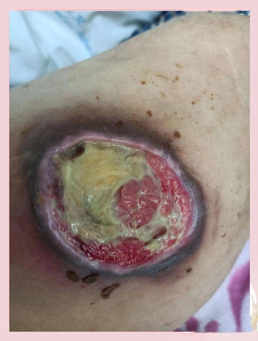 女生开电热毯整夜没翻身得压疮，21岁女生患压疮，预防压疮：简