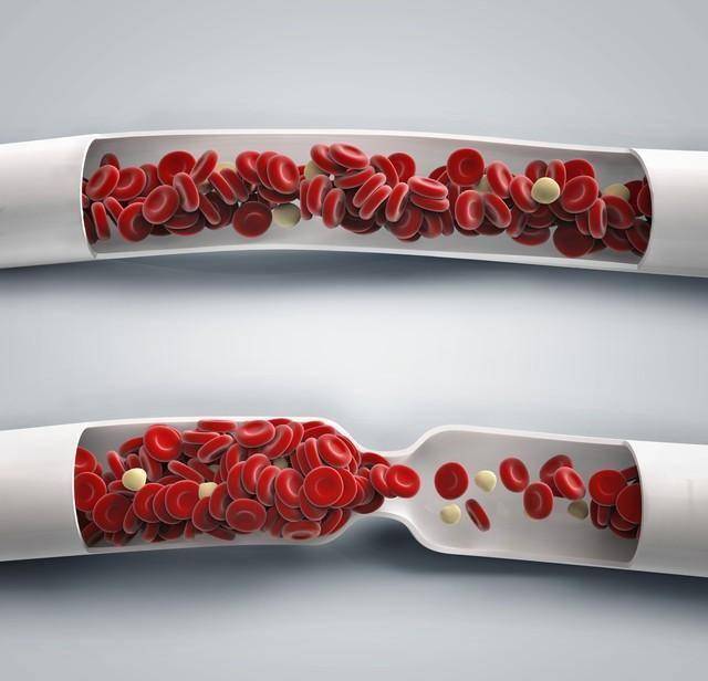 人不会无故患高血脂！调查发现：得高血脂人群多半有这5个特征