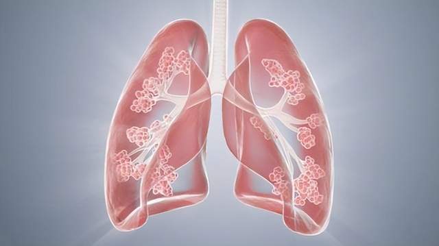 原创            近期白肺高发期，身体出现5类症状及时就医，老人儿童做好预防