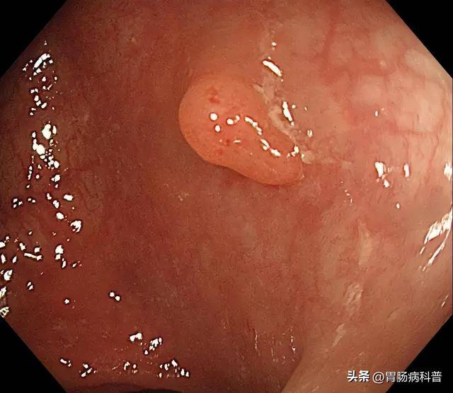 大肠息肉多久会变癌？一文读懂肠癌的“慢动作”演变史