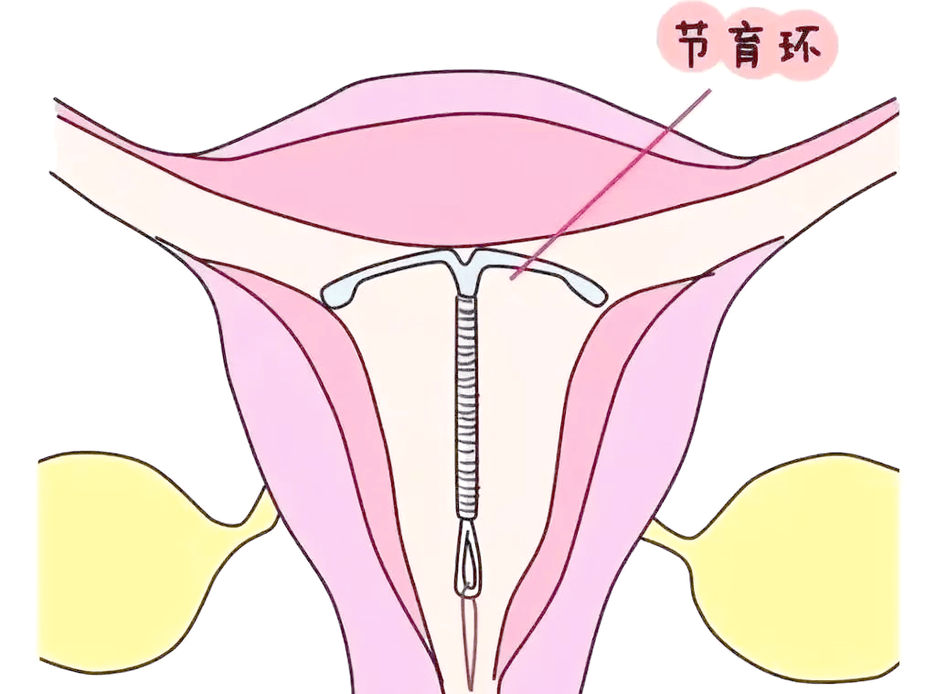 人流术后上环，为子宫筑牢防护盾