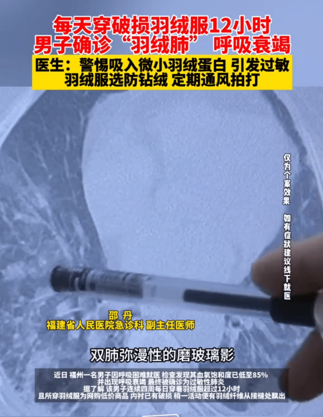 男子确诊“羽绒肺”，出现呼吸衰竭！医生提醒