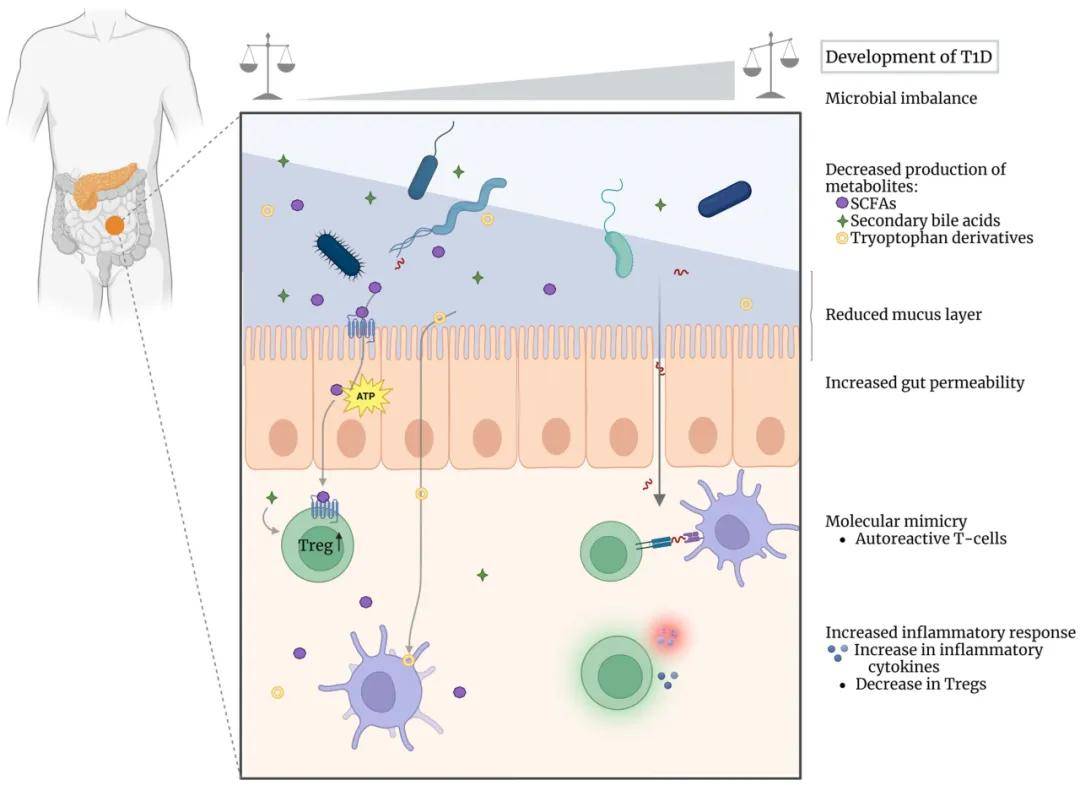 从微生物到代谢物：1型糖尿病肠道微生物组研究进展