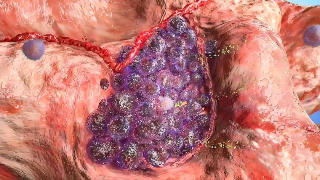 别等晚期才后悔！癌症恶化前的 3 个表现，出现一个都要重视，及时复查！中医防恶化有妙招