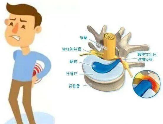跟你一起揭开腰椎疾病的神秘面纱