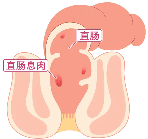 肠息肉哪些容易癌变？哪些需要切除？