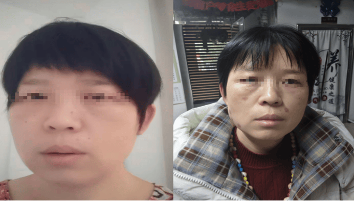 湖南一女子点痣美容变“毁容”？厂家回复：她是找麻烦的