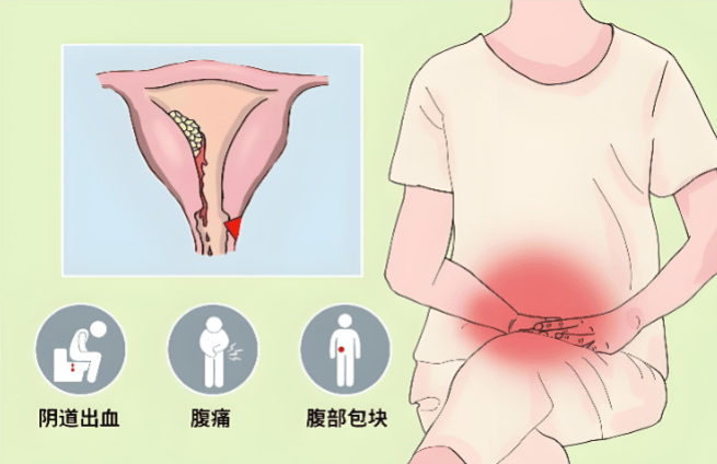 子宫内膜癌术后调理新选择！苏州老中医陈东林的辨证施治之道