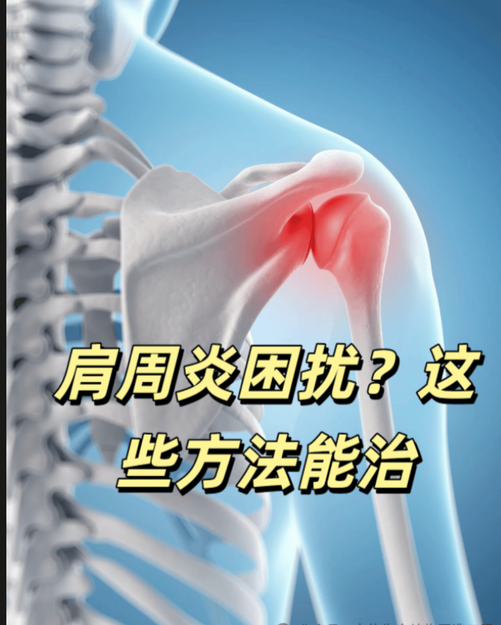 浅谈肩周炎：打破固有认知，解锁不一样的诊疗逻辑
