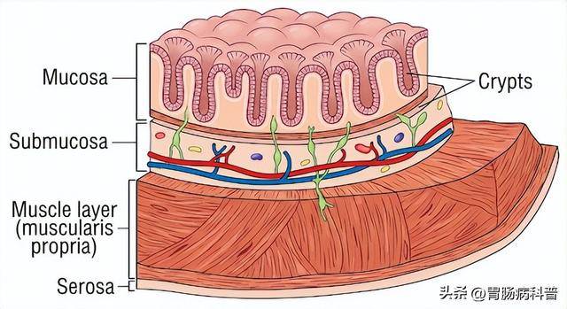 结直肠息肉『高级别上皮内瘤变』，是不是早癌？
