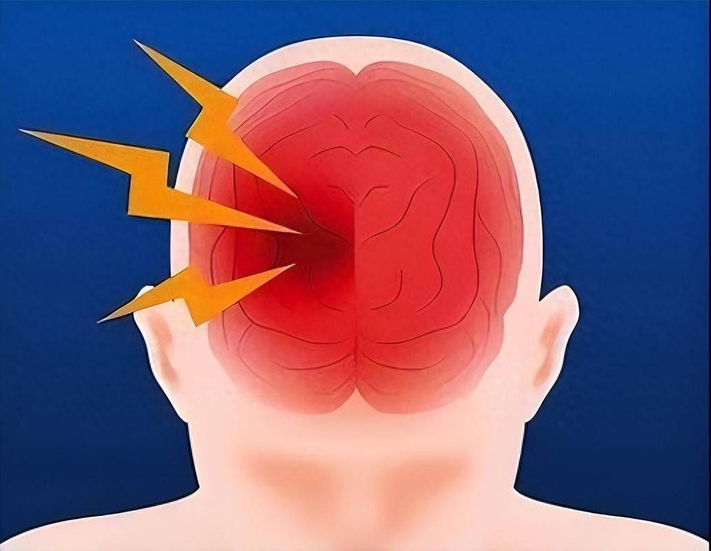 原创            年轻人不会脑出血？错！30岁以下越来越多，突发时这些错误别犯