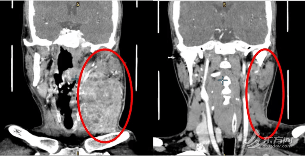 突破“不可手术”困境！上海九院利用靶向免疫联合转化治疗，根治极晚期舌癌