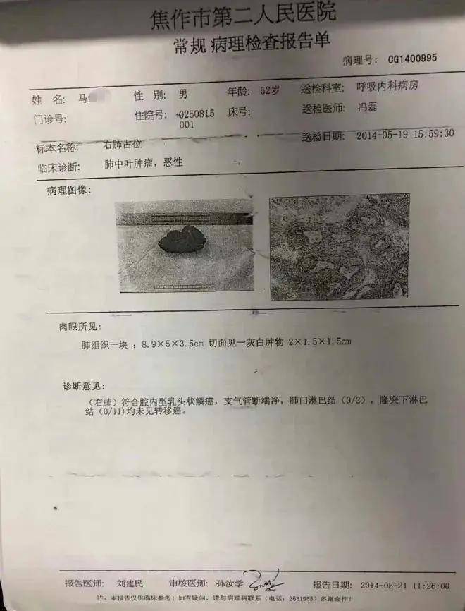 医生说他肺上阴影是癌，十年后复查，他说“结节和以前一样”