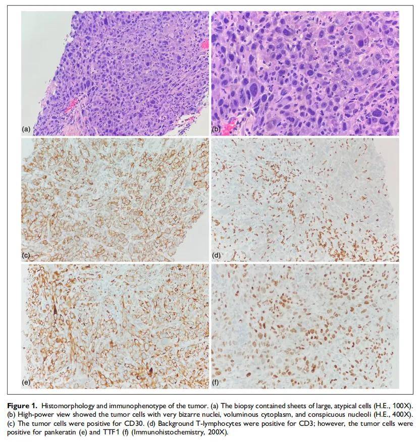 TCR重排阳性=淋巴瘤？NO！多基因检测确诊孤立性TCR重排/MET ex14跳突肺腺癌