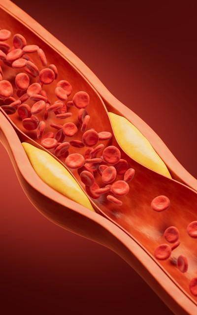 对抗颈动脉斑块不用慌！3个经典小滴丸，降血脂、抗炎抗氧化