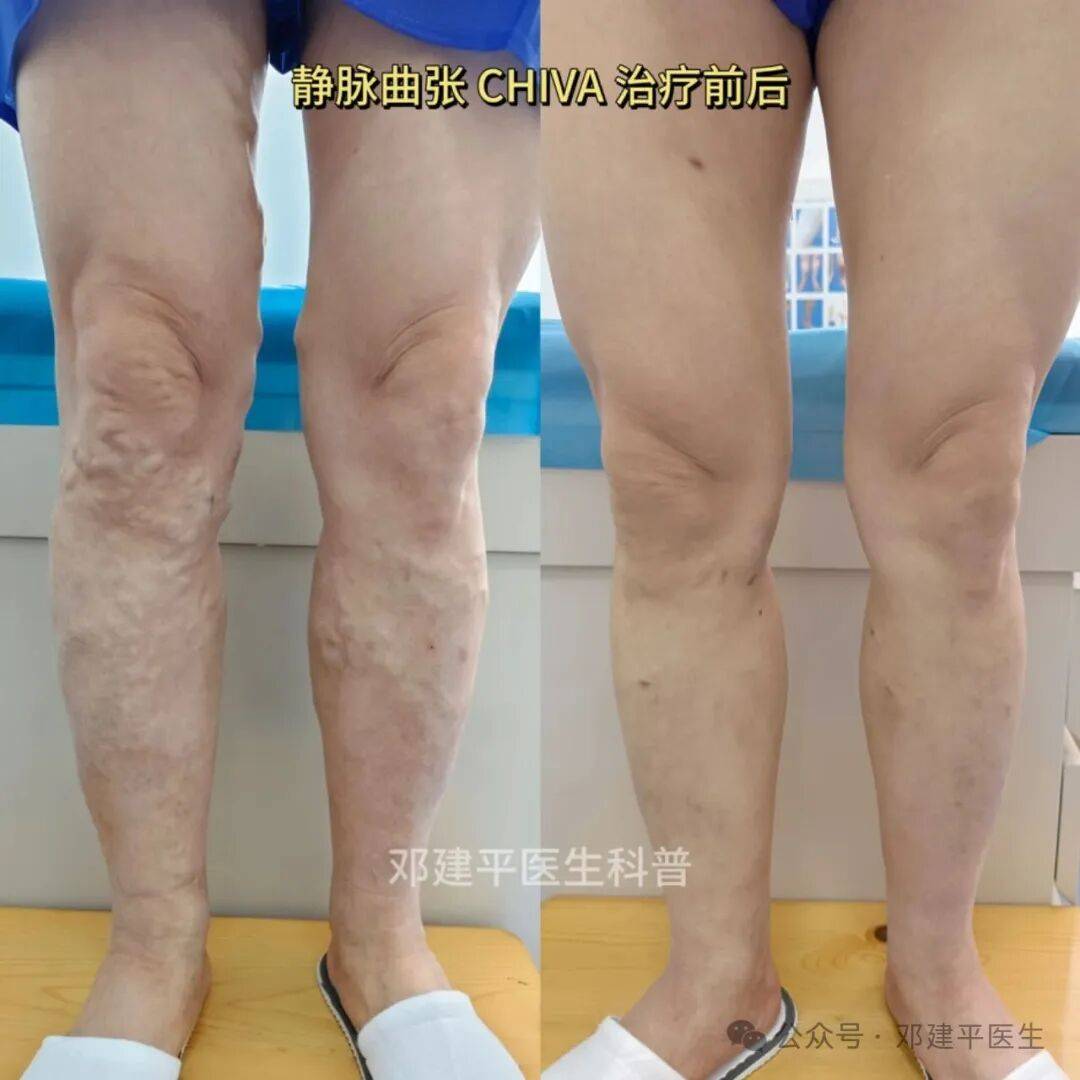 双腿静脉曲张只能分开两次做？