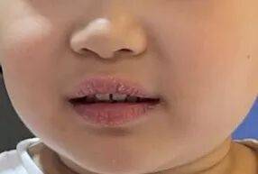 娃唇炎干裂流血？宝妈别慌！