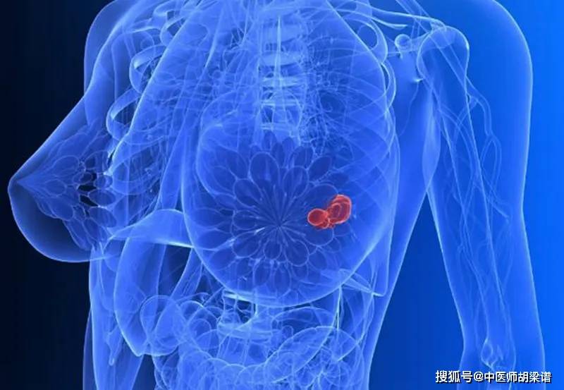 乳腺癌，生存期却相差几十年，问题出在哪？不少人都忽略了