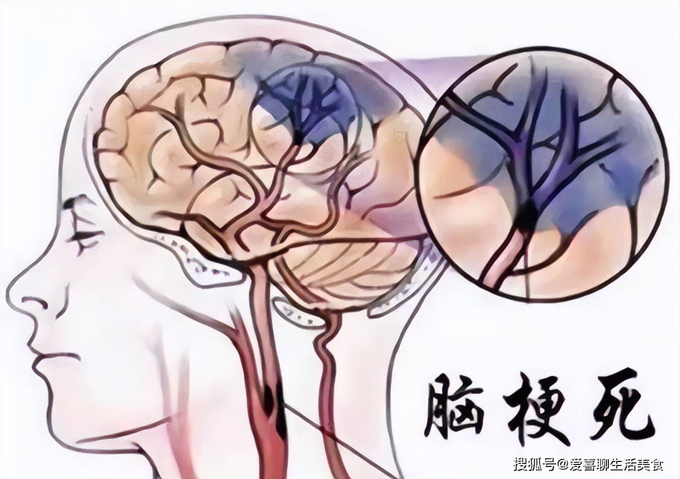 原创            这5类食物可能引起“脑梗”，医生提醒：少吃就对了！
