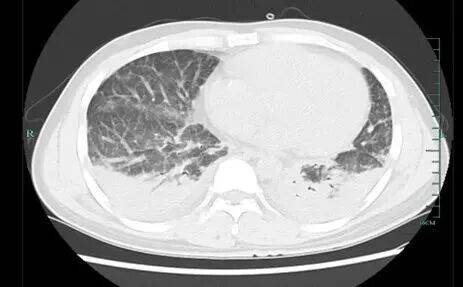 浙江男子为滋补身体抓竹鼠吃，突然高烧，肺都“烂穿”！医生：有极大风险……