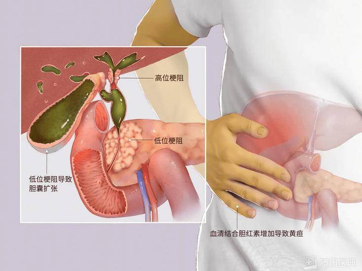 【朝医科普】皮肤眼睛发黄别忽视！一文读懂梗阻性黄疸