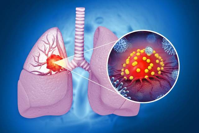 反复咳嗽不是感冒，而是过敏性肺炎在报警，别拖到肺纤维化才后悔