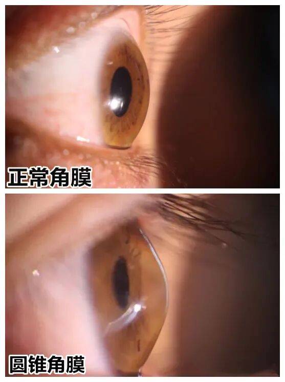 频繁揉眼也可能致眼病？这个青少年视力“隐形杀手”不能不防！