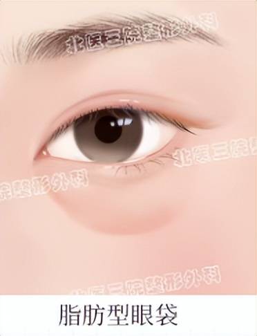 做完眼袋怎么更显老?你可能弄错了类型!