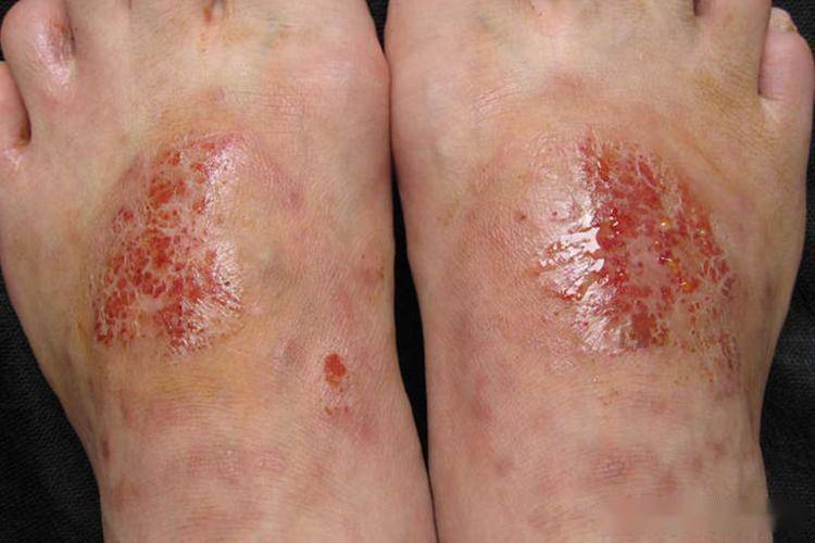 热水烫脚能治脚气？真相让人倒吸一口凉气