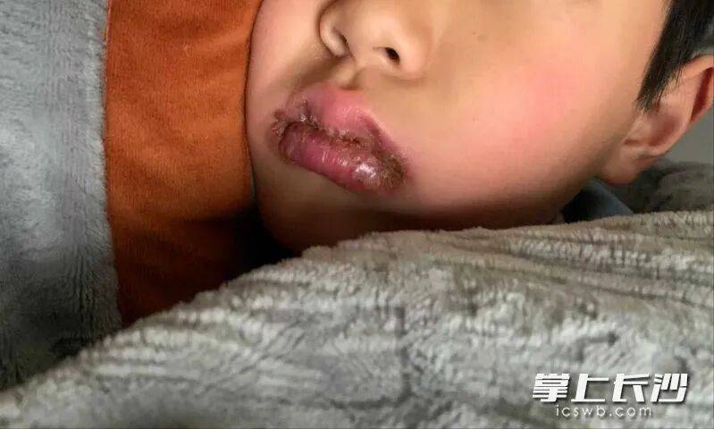 两月接诊500例，超7成是孩子中招！医生提醒