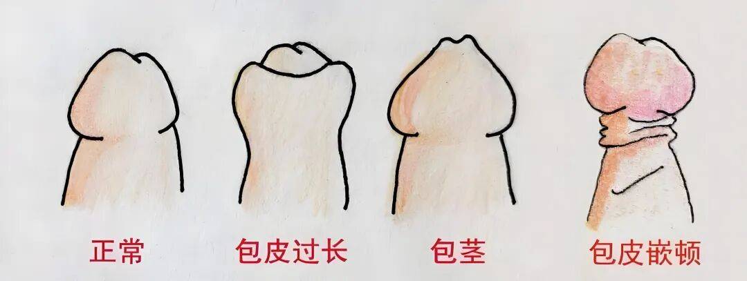 【健康科普】小手术，解决“男”问题