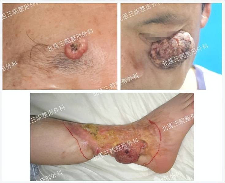 体表肿物之鳞状细胞癌怎么回事儿？