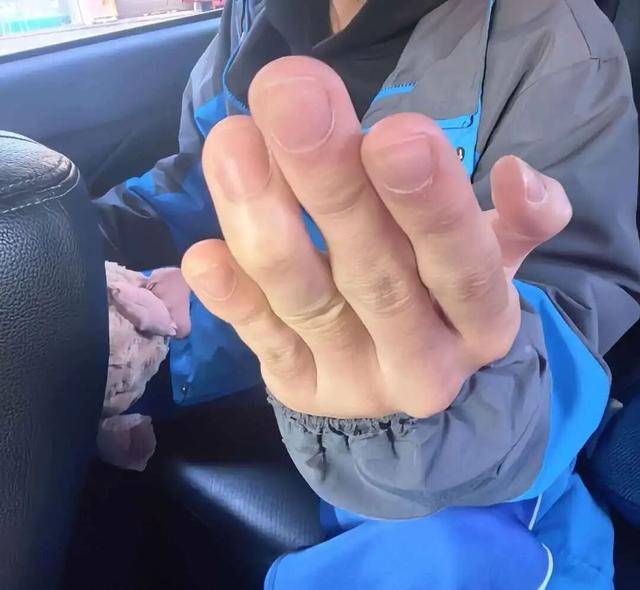 打球戳伤手指，伸直变“小锤”？警惕青少年常见运动伤——锤状指