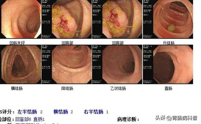29岁小伙腹痛当阑尾炎，结果竟是晚期肠癌！医生：这些症状别硬扛