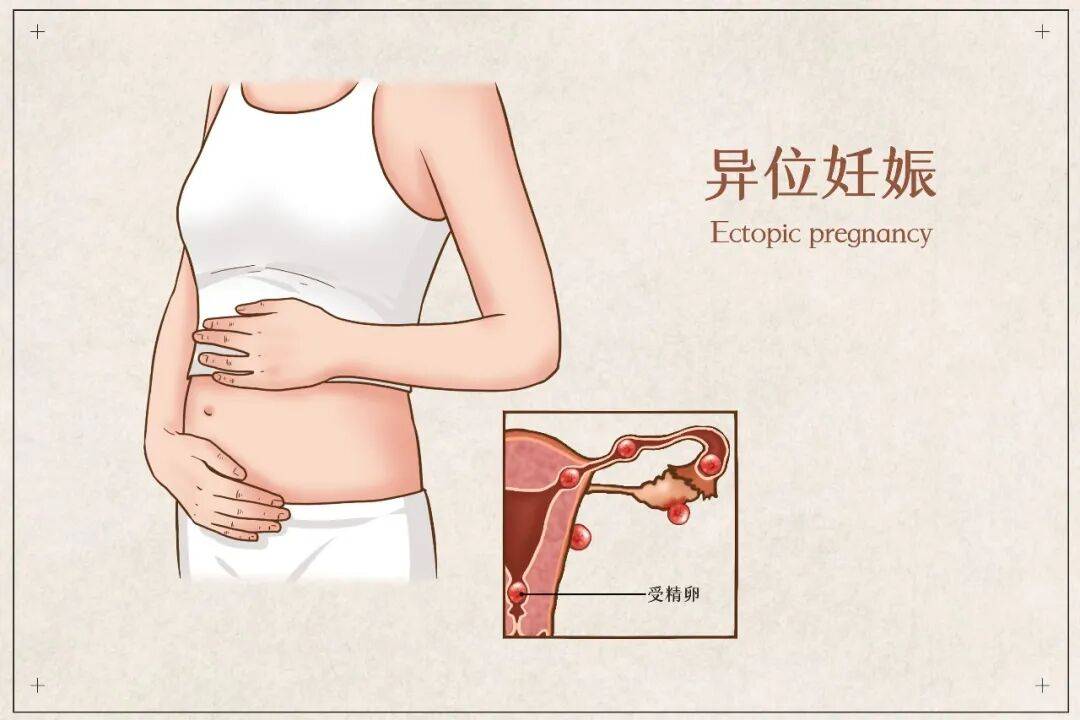 当受精卵“迷路”在输卵管：关于宫外孕，每位女性都该知道的生命警报