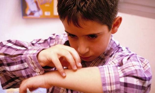 寒冷冬天想要缓解荨麻疹，这三点不可少