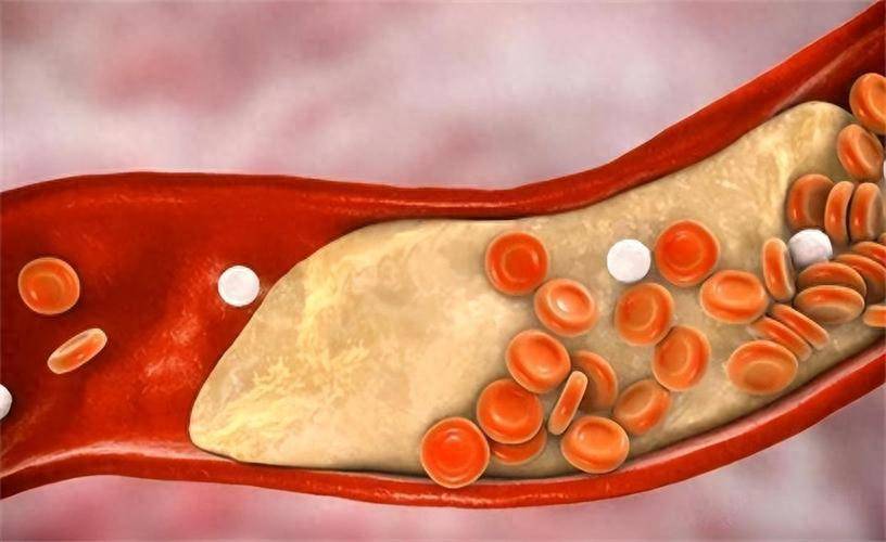 原创            一提到胆固醇，大多数人紧张和回避，医生教你5招科学管理胆固醇