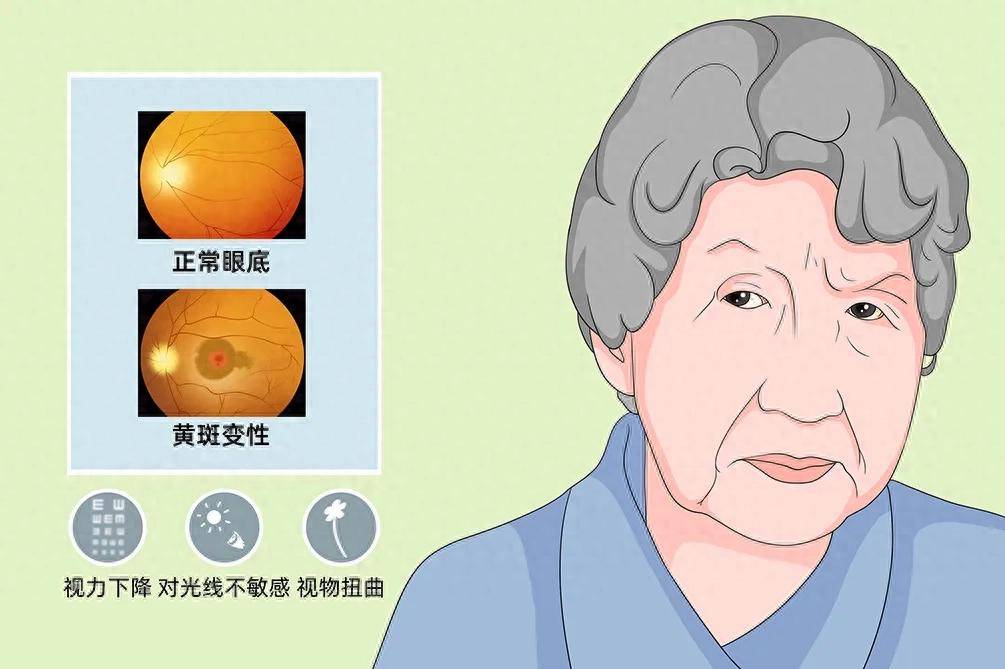 新研究：二甲双胍长期吃，可使1种老年人致盲疾病风险降低37%！