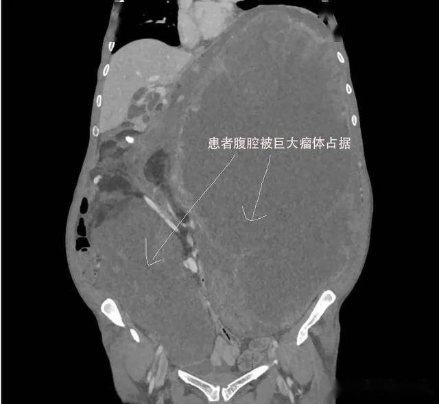 肉瘤二度复发，瘤体重达35斤，北京协和医院这场手术能否改写结局？
