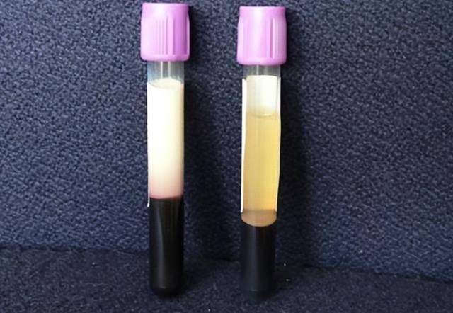 甘油三酯从6.27到1.68，我用了一个月，与大家分享我的经历