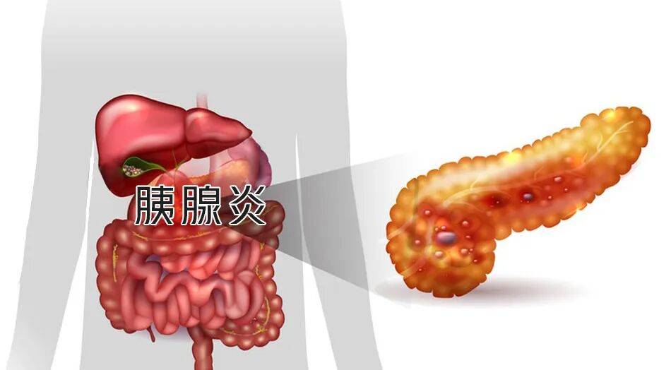 百草益寿：胰腺炎癌变仅“一步之遥”，这种维生素能降低癌变风险