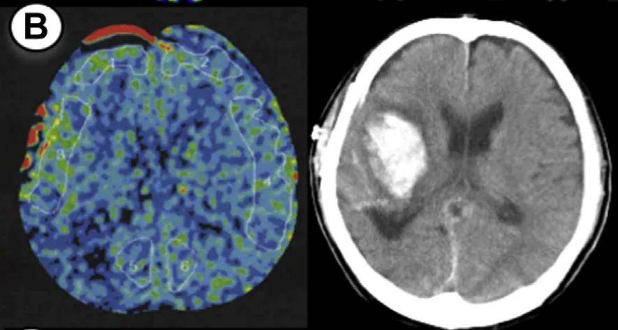 烟雾病术后出血风险预测：脑高灌注综合征预警信号