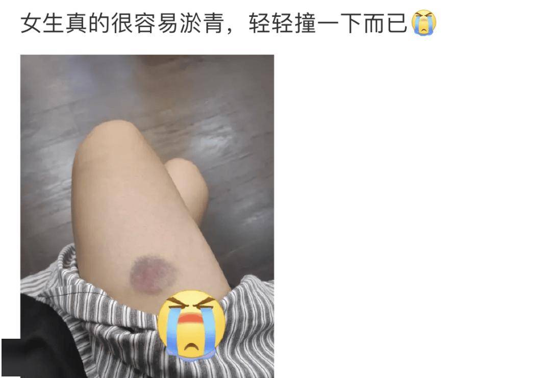 【科普】男性迷之不解：为啥女性身上总有莫名的淤青？