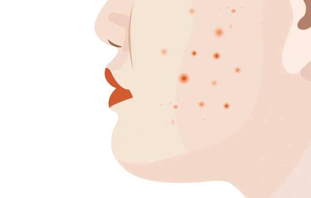 可能影响性功能的“祛痘神药”，很多人在滥用