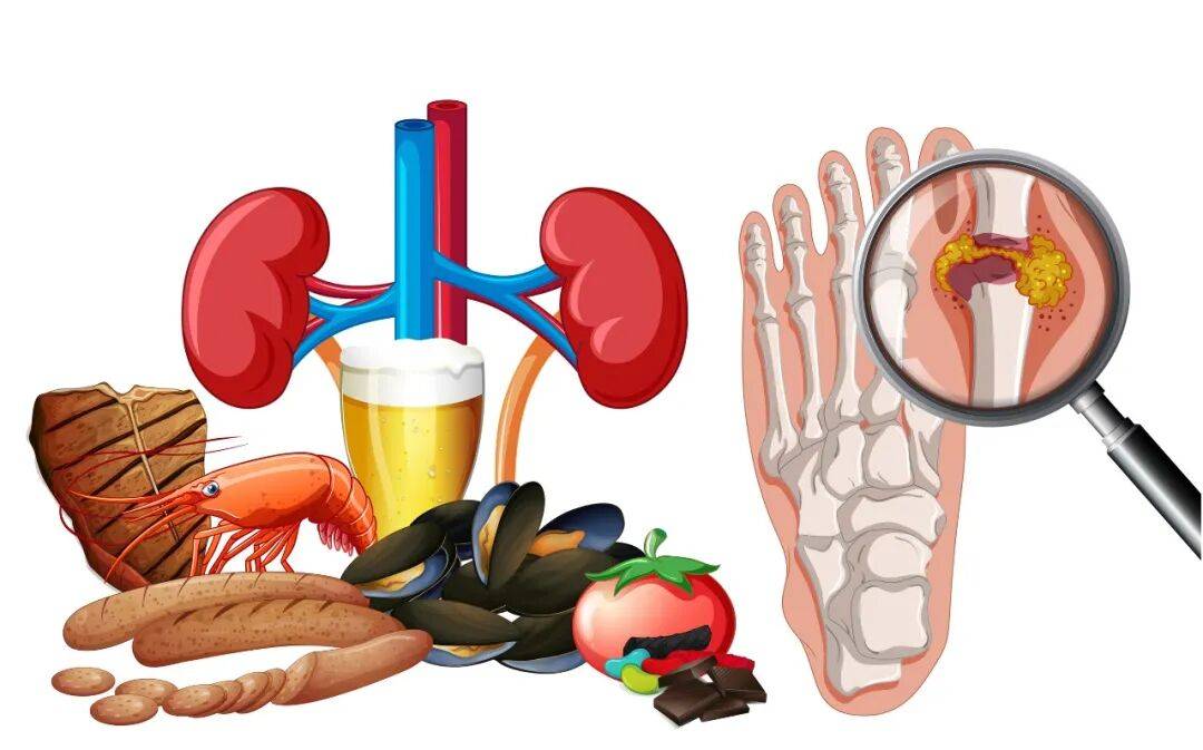 痛风不控制尿酸？危险