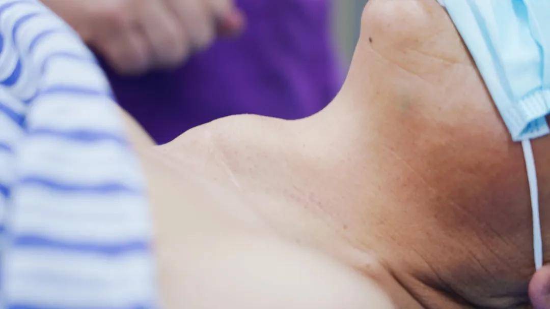 甲状腺癌多半是“拖出来的”？发现多为中晚期，身上出现6种异常，尽早检查