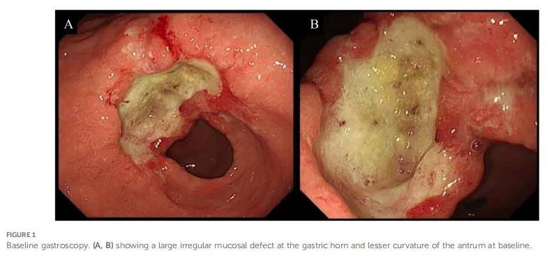 HER2阴性/TMB-H/POLD1突变转移性胃黏液腺癌显著获益免疫联合化疗，PFS超五年